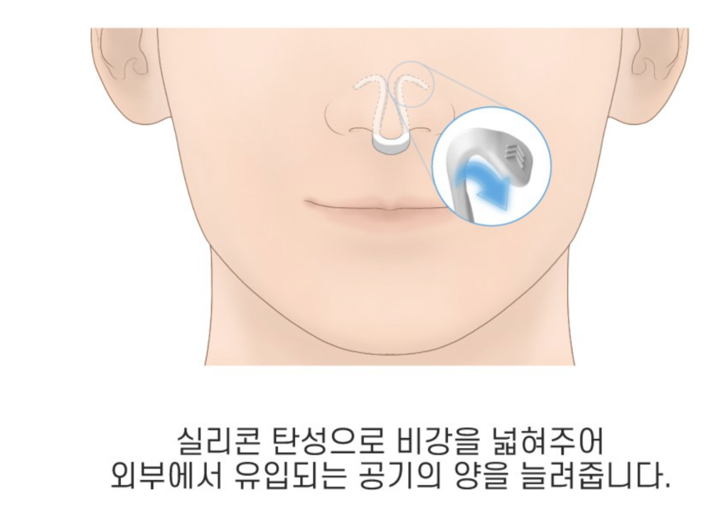 쿠팡 비강 확장